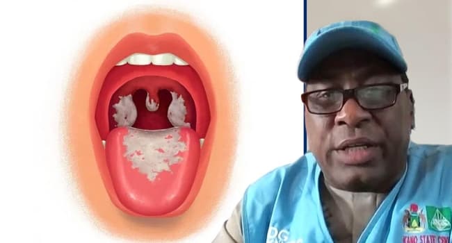 KANO DIPHTHERIA OUTBREAK: 32,633 CASES CONFIRMED, 1,744 DEATHS — KNCDC